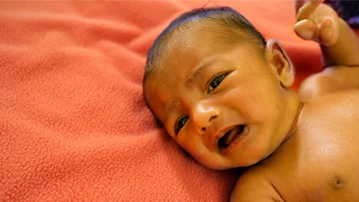 Neonatal jaundice